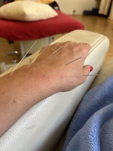 Akupunkturbehaundlung in Berlin bei Heilpraktikerin Sandra Wilfert